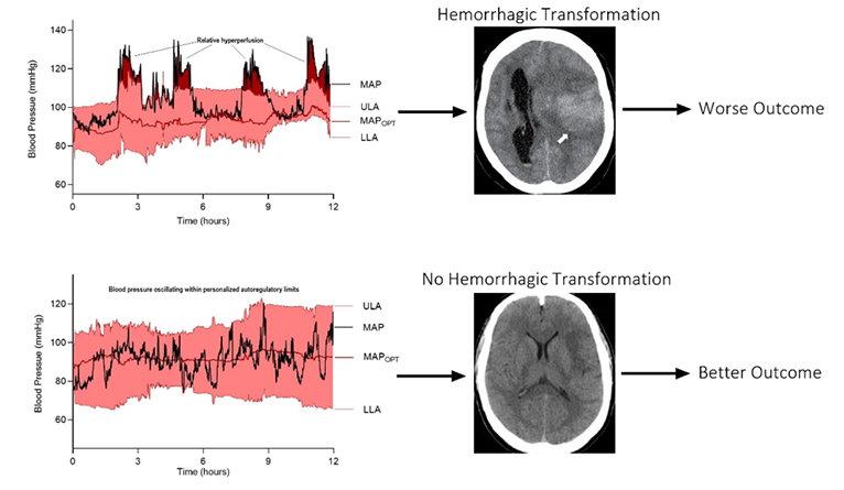 Diagram comparing brain scans with and without evidence of hemorrhagic transformation.