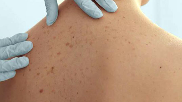 sebaceous carcinoma sebaceous carcinoma